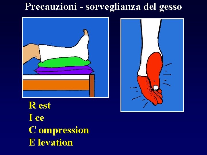 Precauzioni - sorveglianza del gesso R est I ce C ompression E levation 