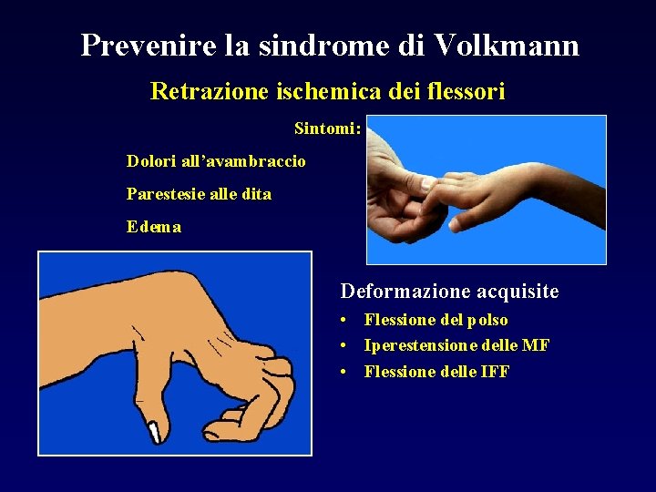 Prevenire la sindrome di Volkmann Retrazione ischemica dei flessori Sintomi: Dolori all’avambraccio Parestesie alle