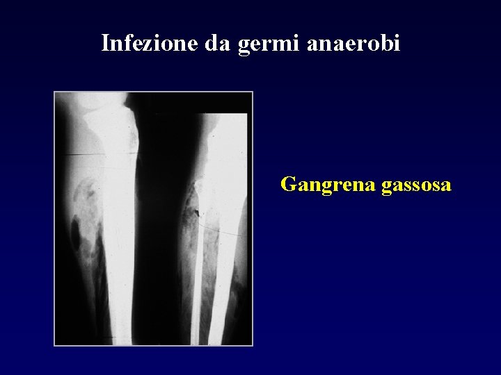 Infezione da germi anaerobi Gangrena gassosa 