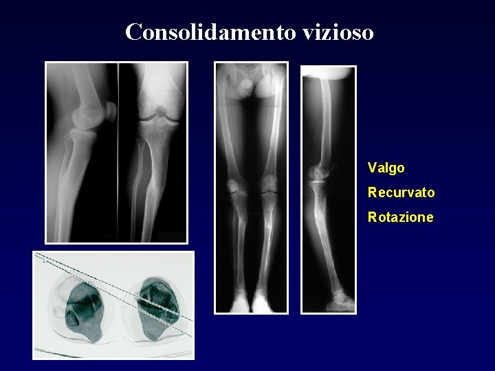 Consolidamento vizioso Valgo Recurvato Rotazione 