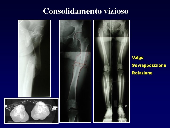 Consolidamento vizioso Valgo Sovrapposizione Rotazione 