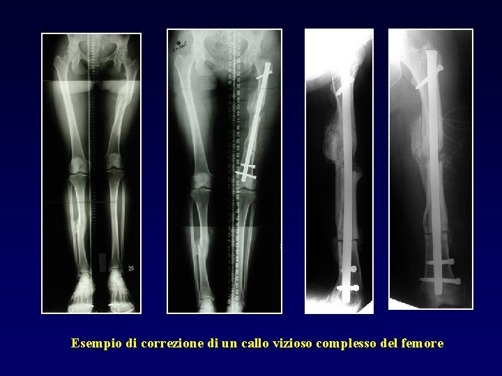 Esempio di correzione di un callo vizioso complesso del femore 