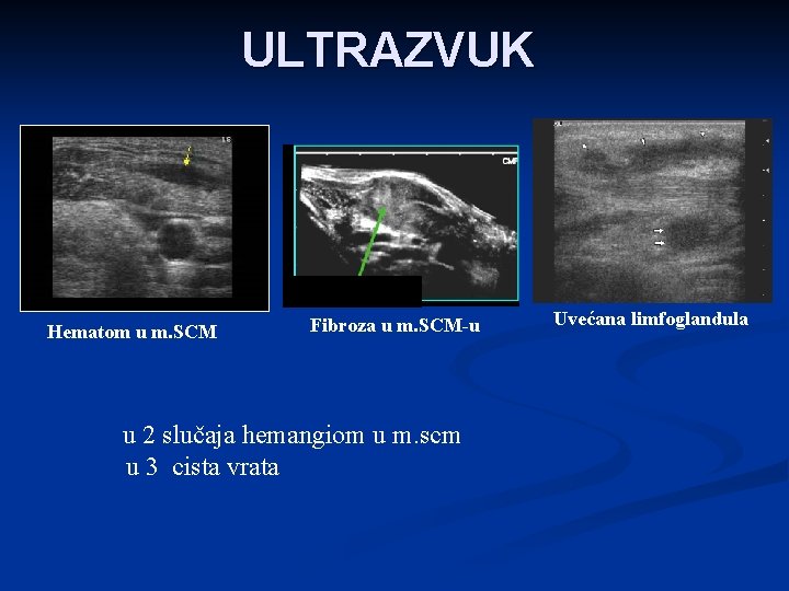 ULTRAZVUK Hematom u m. SCM Fibroza u m. SCM-u u 2 slučaja hemangiom u