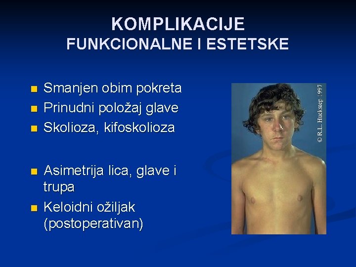 KOMPLIKACIJE FUNKCIONALNE I ESTETSKE n n n Smanjen obim pokreta Prinudni položaj glave Skolioza,