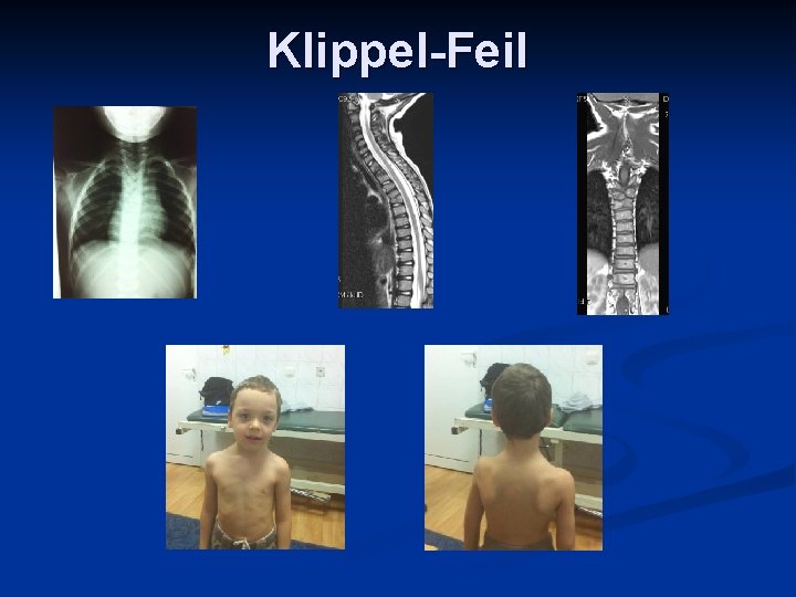Klippel-Feil 