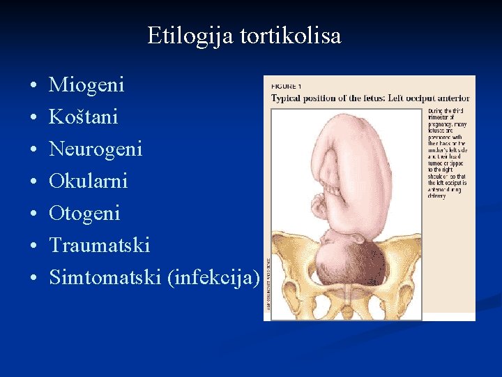 Etilogija tortikolisa • • Miogeni Koštani Neurogeni Okularni Otogeni Traumatski Simtomatski (infekcija) 