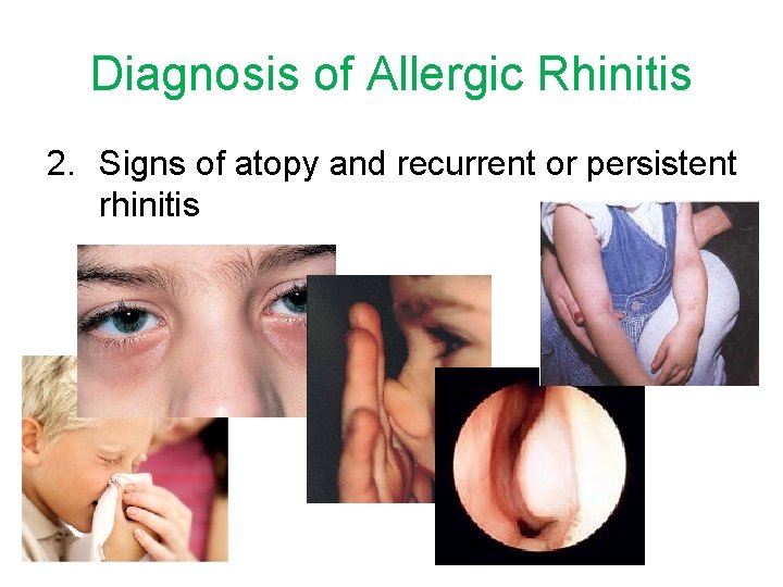 Diagnosis of Allergic Rhinitis 2. Signs of atopy and recurrent or persistent rhinitis 