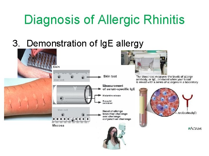 Diagnosis of Allergic Rhinitis 3. Demonstration of Ig. E allergy 