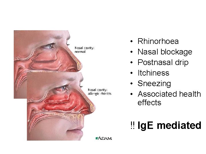  • • • Rhinorhoea Nasal blockage Postnasal drip Itchiness Sneezing Associated health effects