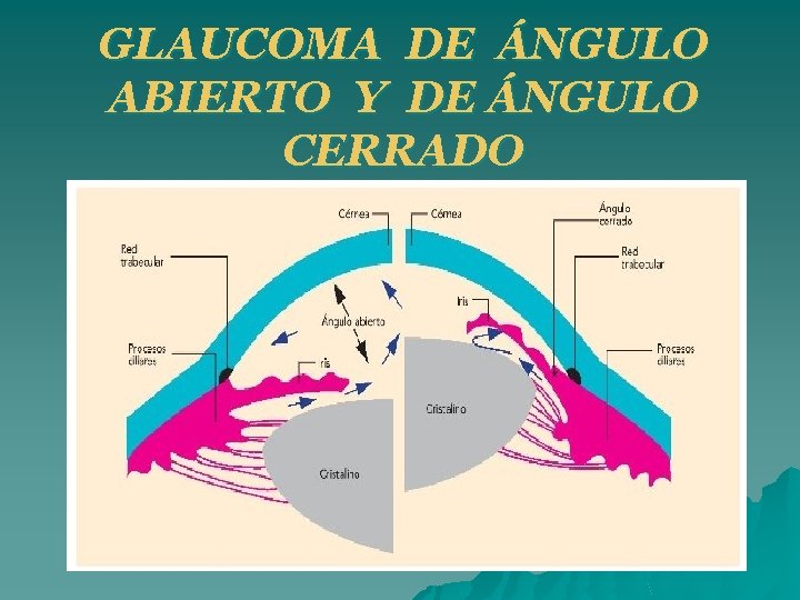 GLAUCOMA DE ÁNGULO ABIERTO Y DE ÁNGULO CERRADO 