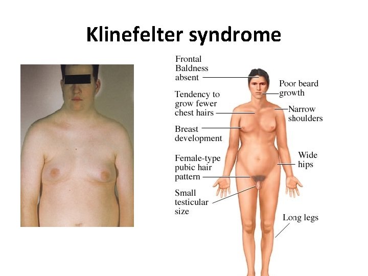 Klinefelter syndrome 