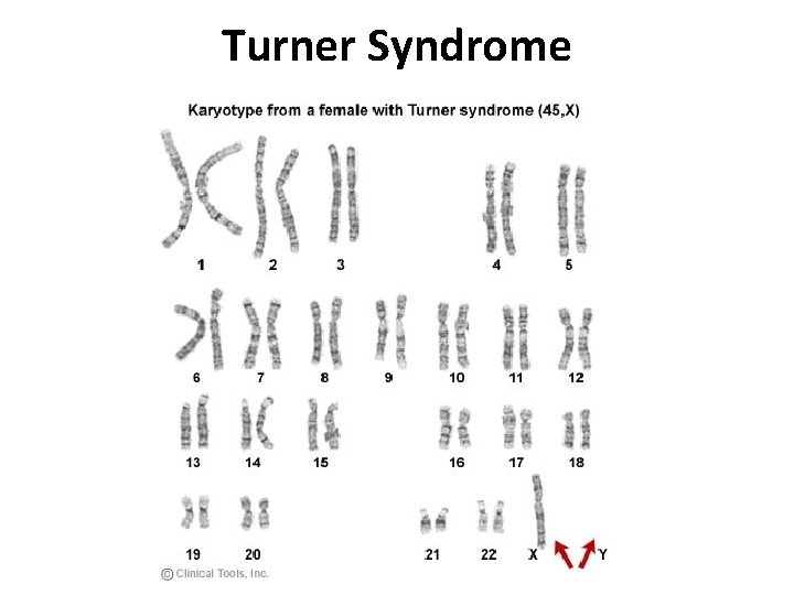 Turner Syndrome 