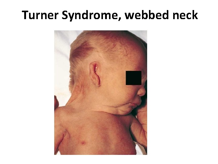 Turner Syndrome, webbed neck 