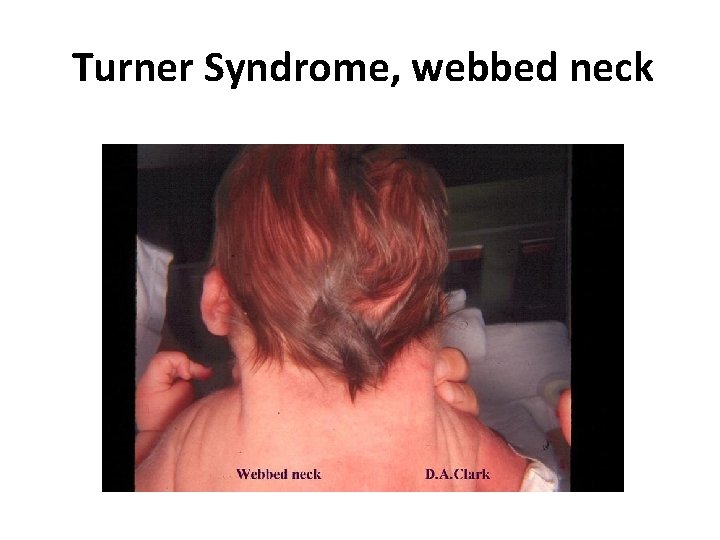 Turner Syndrome, webbed neck 