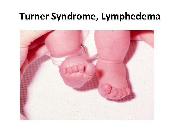 Turner Syndrome, Lymphedema 