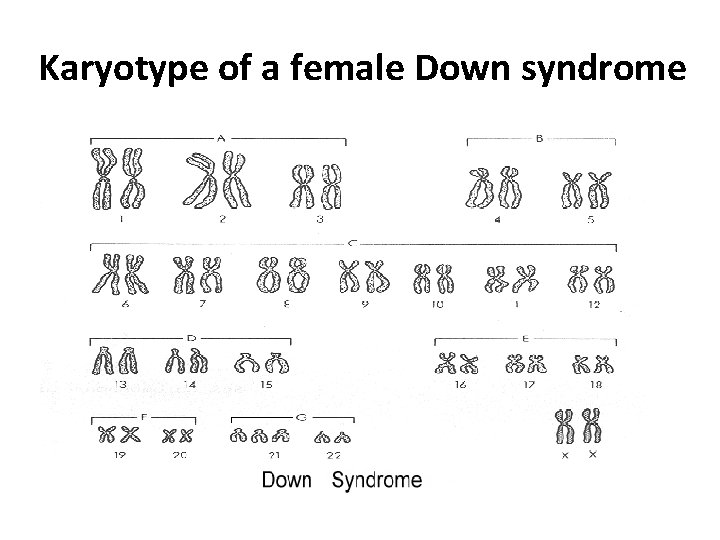 Karyotype of a female Down syndrome 