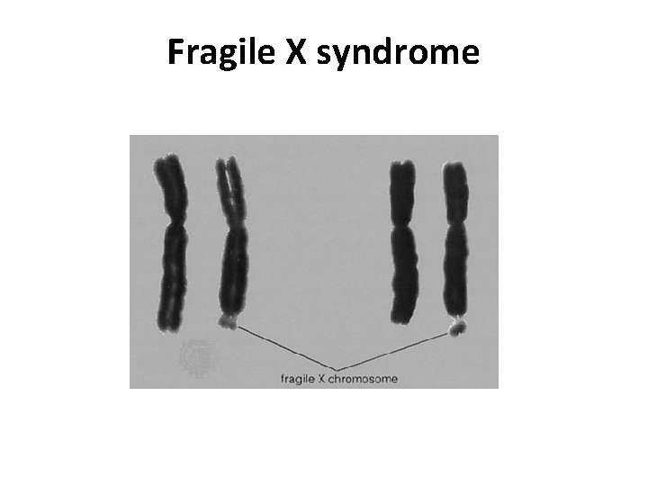 Fragile X syndrome 