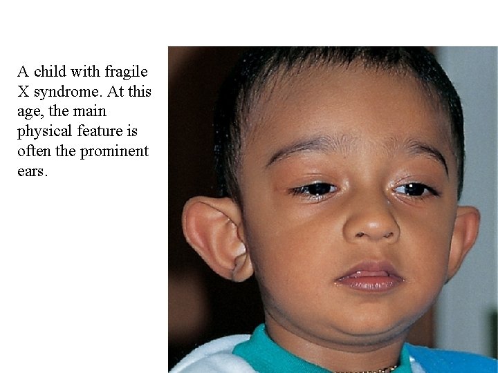 A child with fragile X syndrome. At this age, the main physical feature is