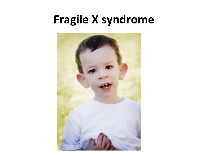 Fragile X syndrome 
