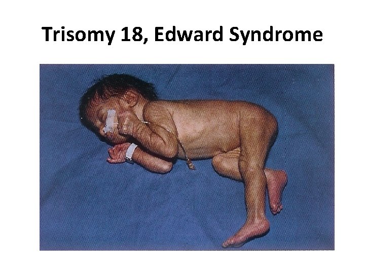 Trisomy 18, Edward Syndrome 