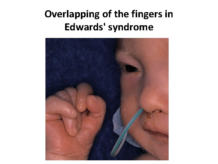 Overlapping of the fingers in Edwards' syndrome 