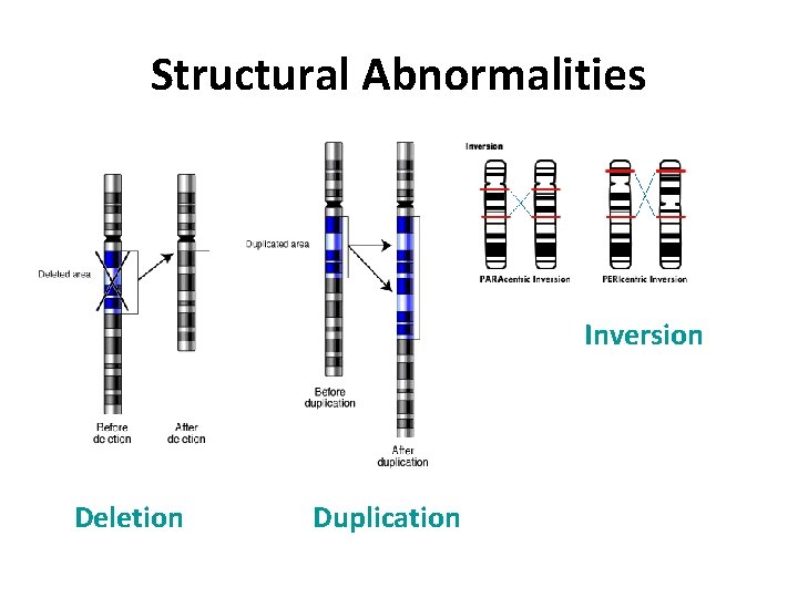 Structural Abnormalities Inversion Deletion Duplication 