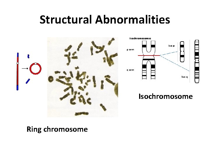 Structural Abnormalities Isochromosome Ring chromosome 