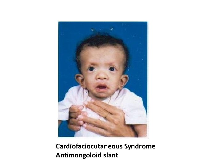 Cardiofaciocutaneous Syndrome Antimongoloid slant 