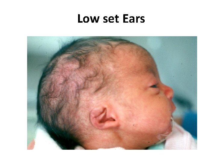 Low set Ears 