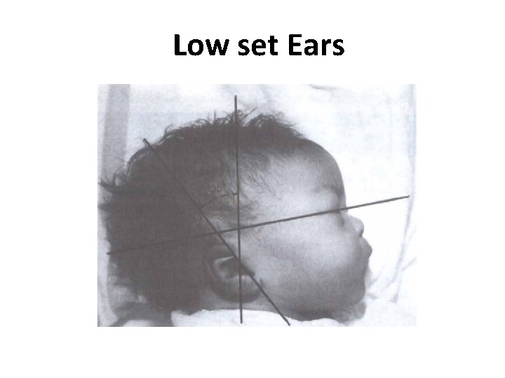 Low set Ears 