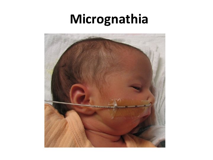 Micrognathia 