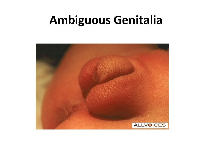 Ambiguous Genitalia 