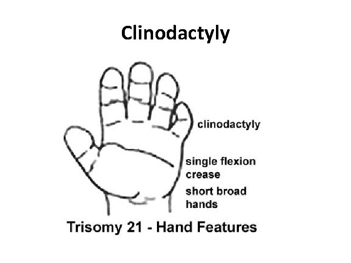 Clinodactyly 