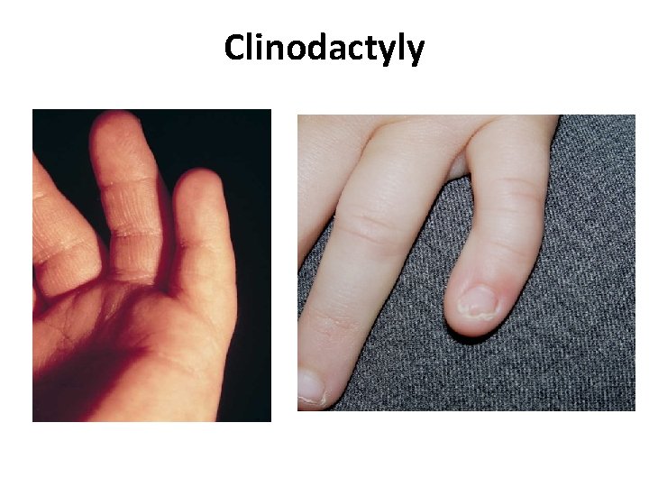 Clinodactyly 