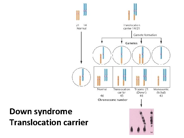 Down syndrome Translocation carrier 