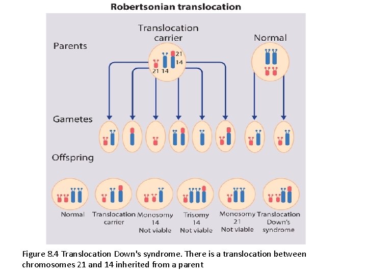 Figure 8. 4 Translocation Down's syndrome. There is a translocation between chromosomes 21 and