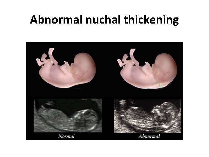 Abnormal nuchal thickening 