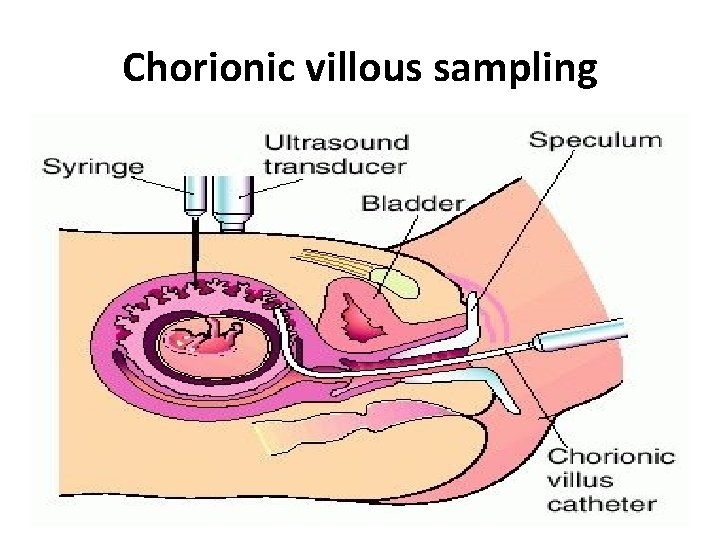 Chorionic villous sampling 