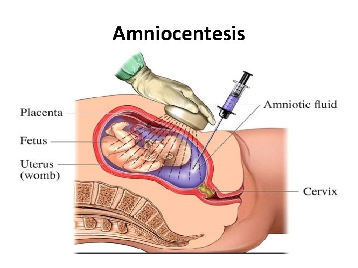 Amniocentesis 