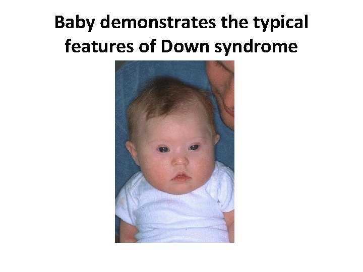 Baby demonstrates the typical features of Down syndrome 