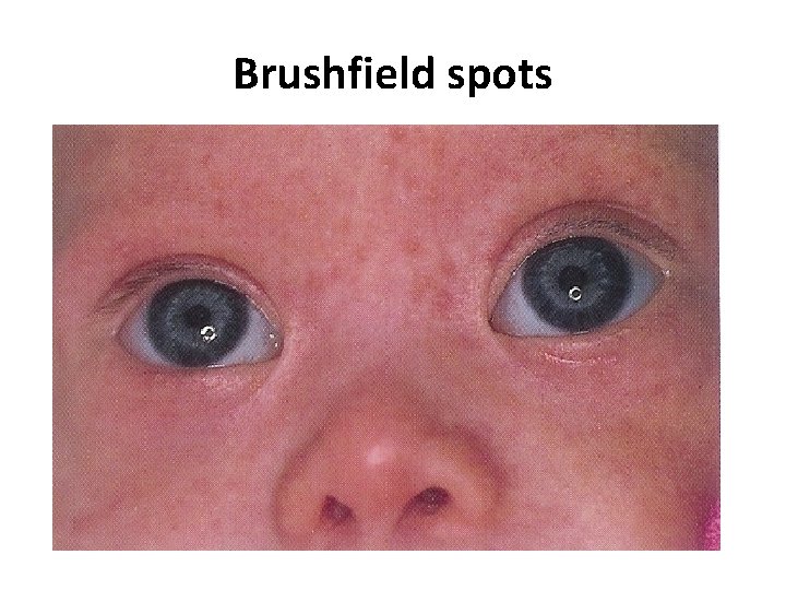 Brushfield spots 