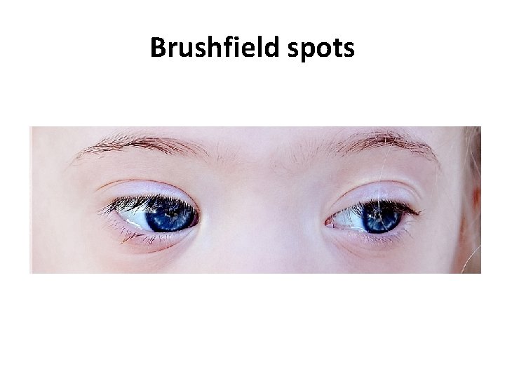 Brushfield spots 