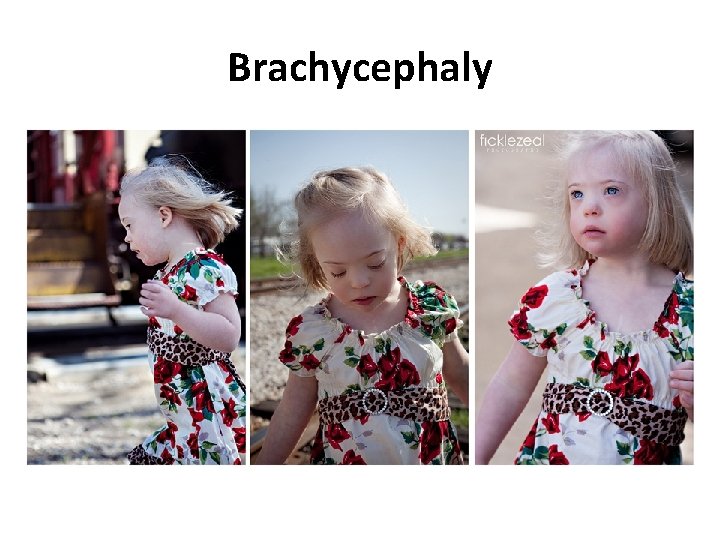 Brachycephaly 