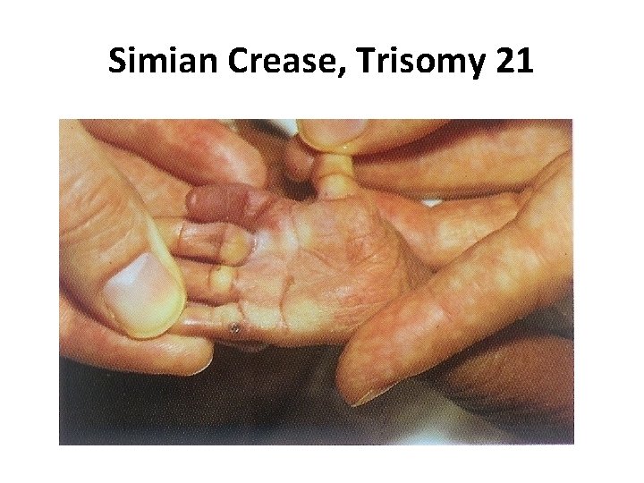 Simian Crease, Trisomy 21 