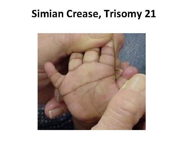 Simian Crease, Trisomy 21 