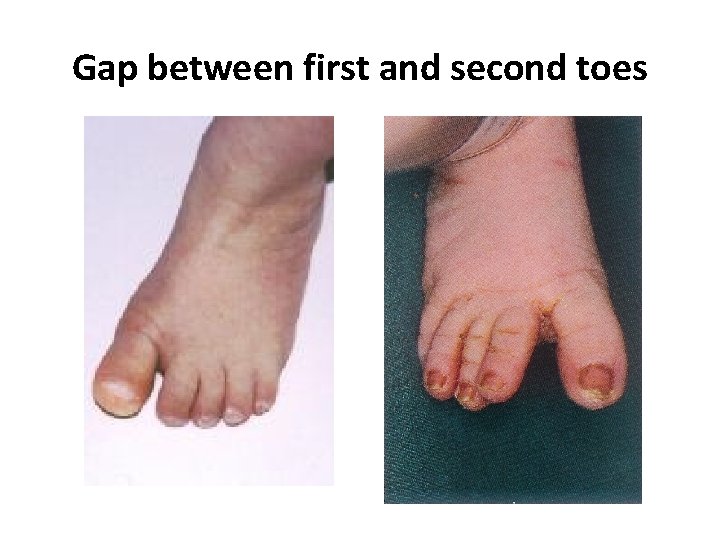 Gap between first and second toes 