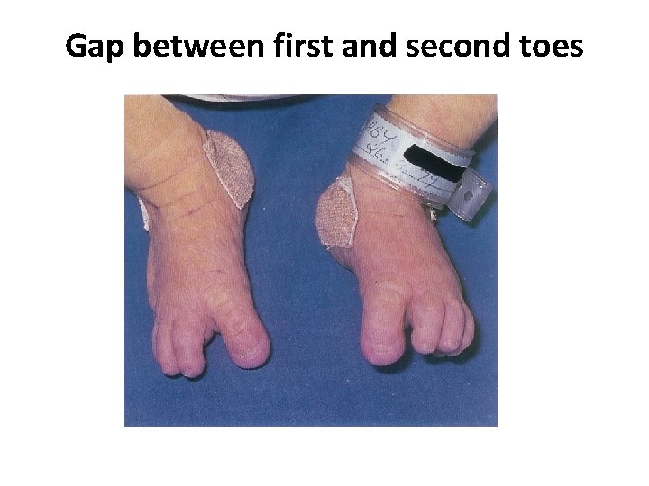 Gap between first and second toes 