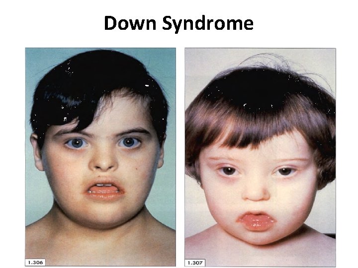 Down Syndrome 