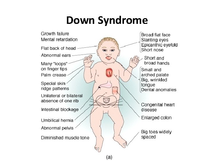 Down Syndrome 