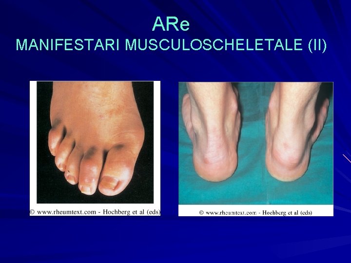ARe MANIFESTARI MUSCULOSCHELETALE (II) ARe MANIFESTARI MUSCULOSCHELETALE (II)
